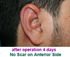 plastic-surgery-prominent-ear 